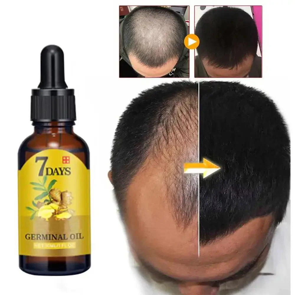 Hair Care Essential Oil Atomizing - Hair Growth Ginger Fast Growing Hair