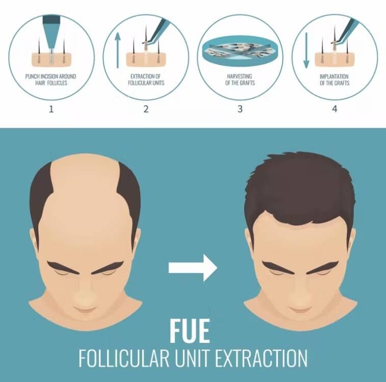 FUE Hair Implant Micro Motor H - Hair Care Basic recension och pris